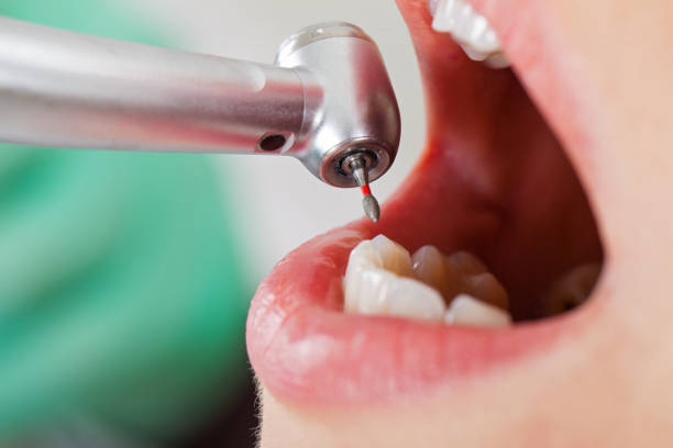 Best Emergency Dental Care for Broken or Chipped Teeth in , MD